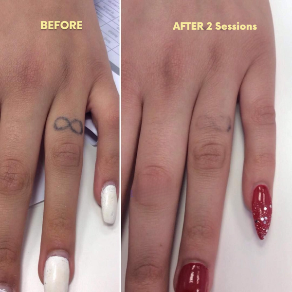 Tattoo Removal Laser Pen | Swift, Powerful & Safe for Effective Pigment Breakdown