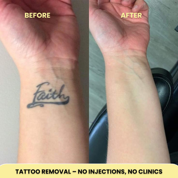 Tattoo Removal Laser Pen | Swift, Powerful & Safe for Effective Pigment Breakdown