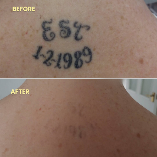 Tattoo Removal Laser Pen | Swift, Powerful & Safe for Effective Pigment Breakdown