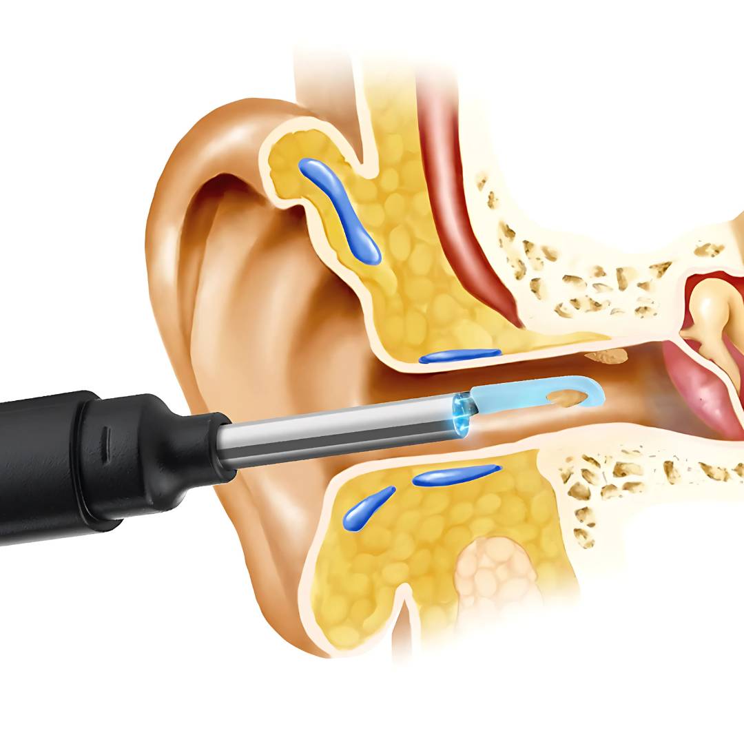 Earwax Removal Tool | Smart Visual with LED Camera & Soft Tips for Safe, Precise Ear Cleaning