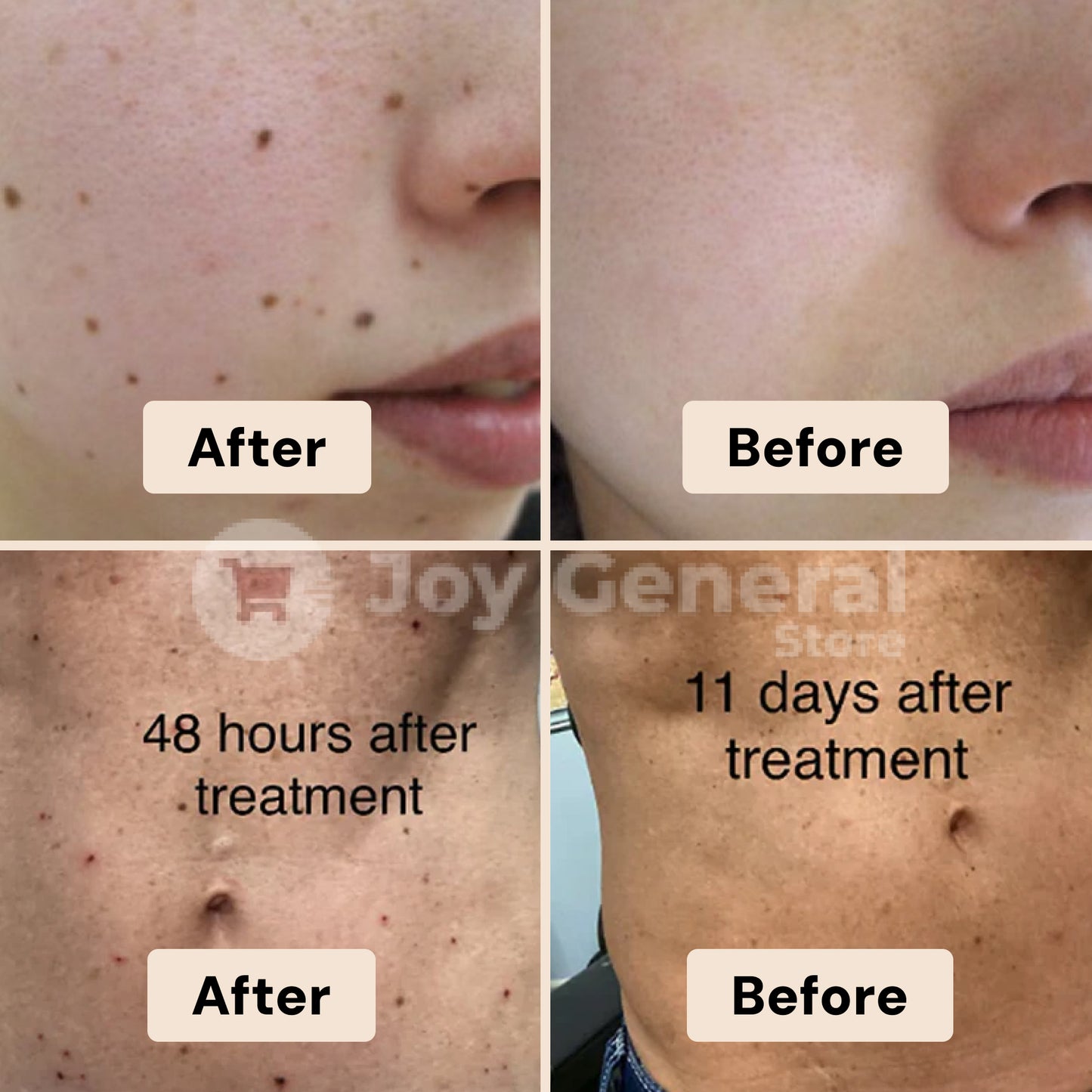 Picosecond Laser Pen for Dark Spot Removal - Light Therapy Skin Treatment Device for Hyperpigmentation and Age Spots