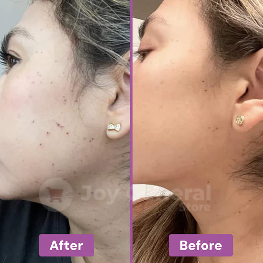 ClearSkinPro Laser Plasma Pen | Non-Invasive Freckle, Skin Tag, Spot, Mole & Tattoo Removal for At-Home Skin Care