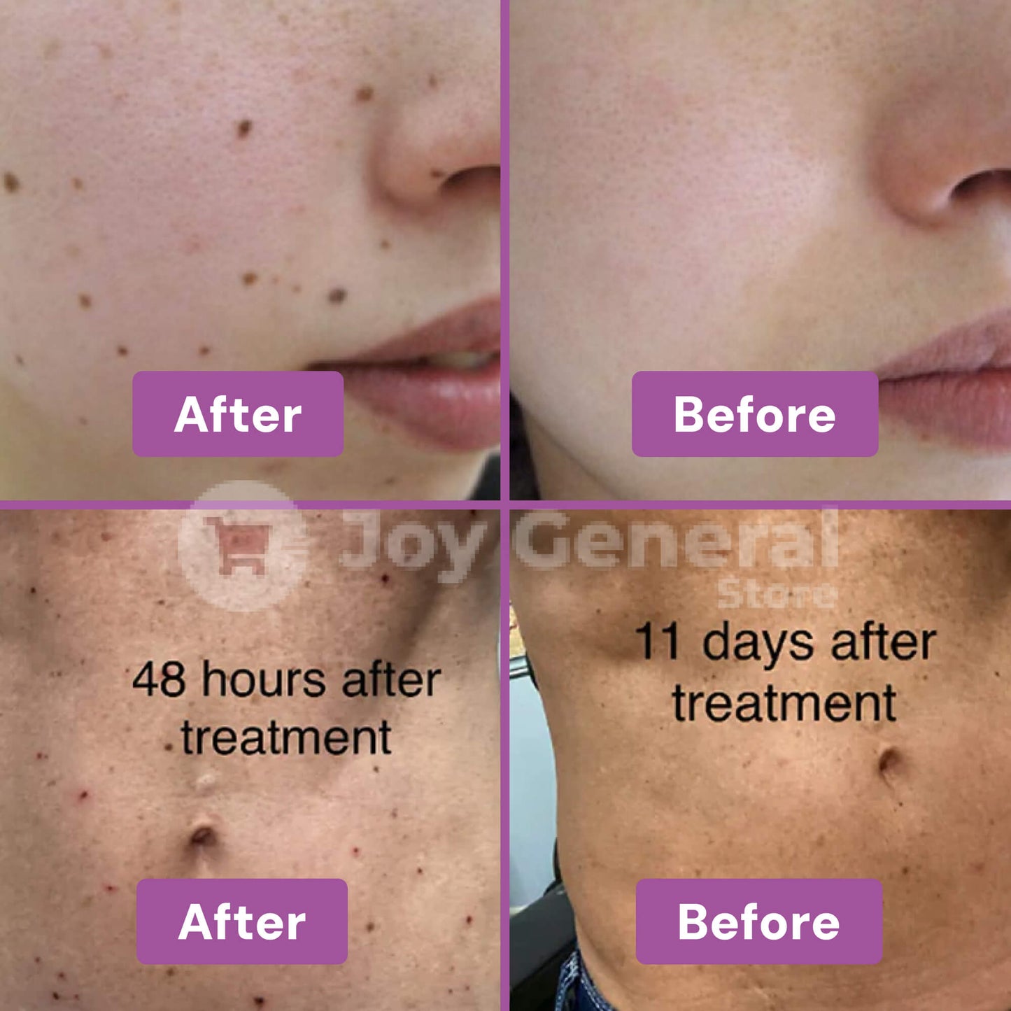 ClearSkinPro Laser Plasma Pen | Non-Invasive Freckle, Skin Tag, Spot, Mole & Tattoo Removal for At-Home Skin Care