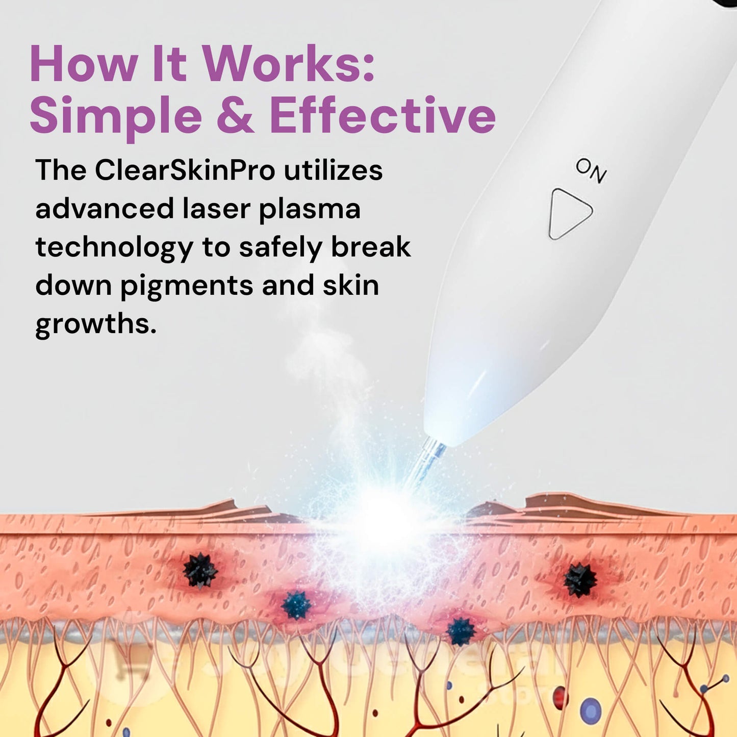 ClearSkinPro Laser Plasma Pen | Non-Invasive Freckle, Skin Tag, Spot, Mole & Tattoo Removal for At-Home Skin Care