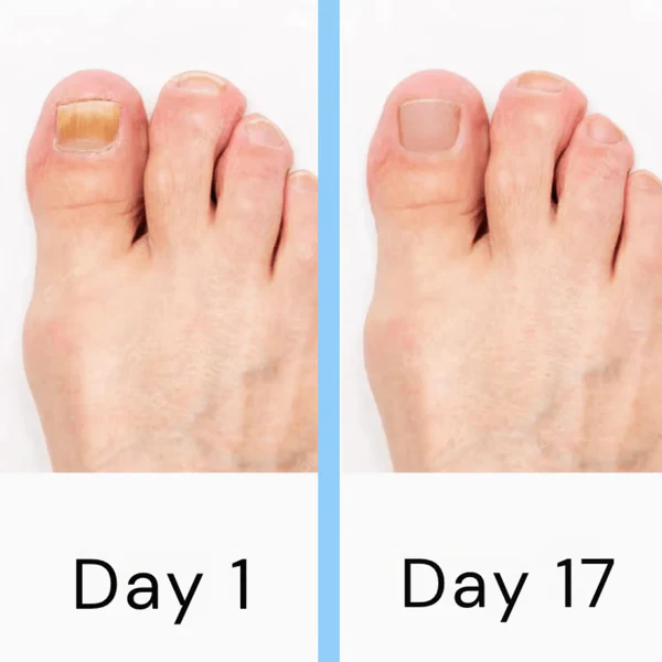 Nail Laser Fungus Device | Non-Invasive, FDA-Cleared Treatment for Fingernail & Toenail Fungus at Home