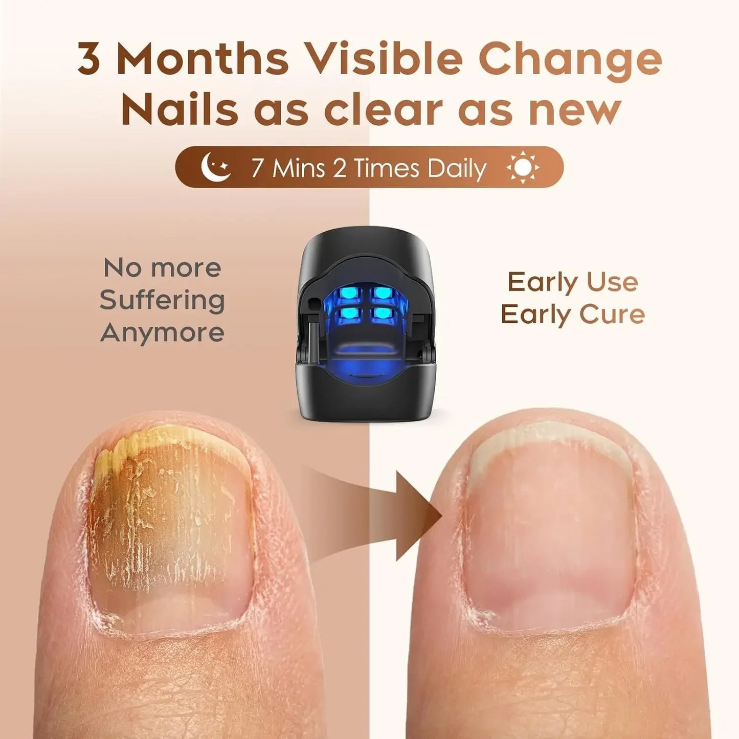 LumiCure PRO 2.0 - Mycosis Nail Fungus Treatment Laser Device for Effective Fungal Infection Removal at Home