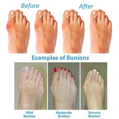 Orthopedic Bunion Corrector Sandals | Adjustable Straps, Arch Support, Comfortable Fit for Foot Pain Relief