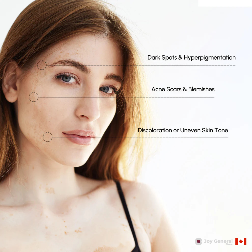 Picosecond Laser Pen for Dark Spot Removal - Light Therapy Skin Treatment Device for Hyperpigmentation and Age Spots