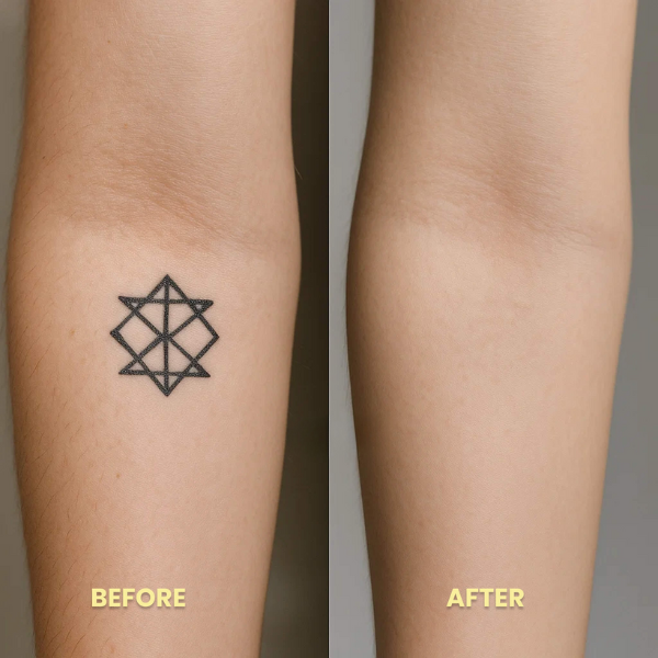 Tattoo Removal Laser Pen | Swift, Powerful & Safe for Effective Pigment Breakdown