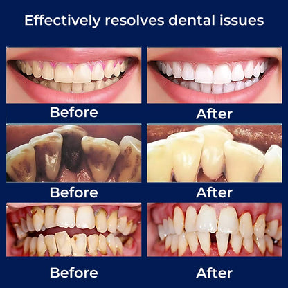 Ultrasonic Teeth Cleaner | Deep Plaque & Tartar Remover for Home Use, Promotes Gum Health