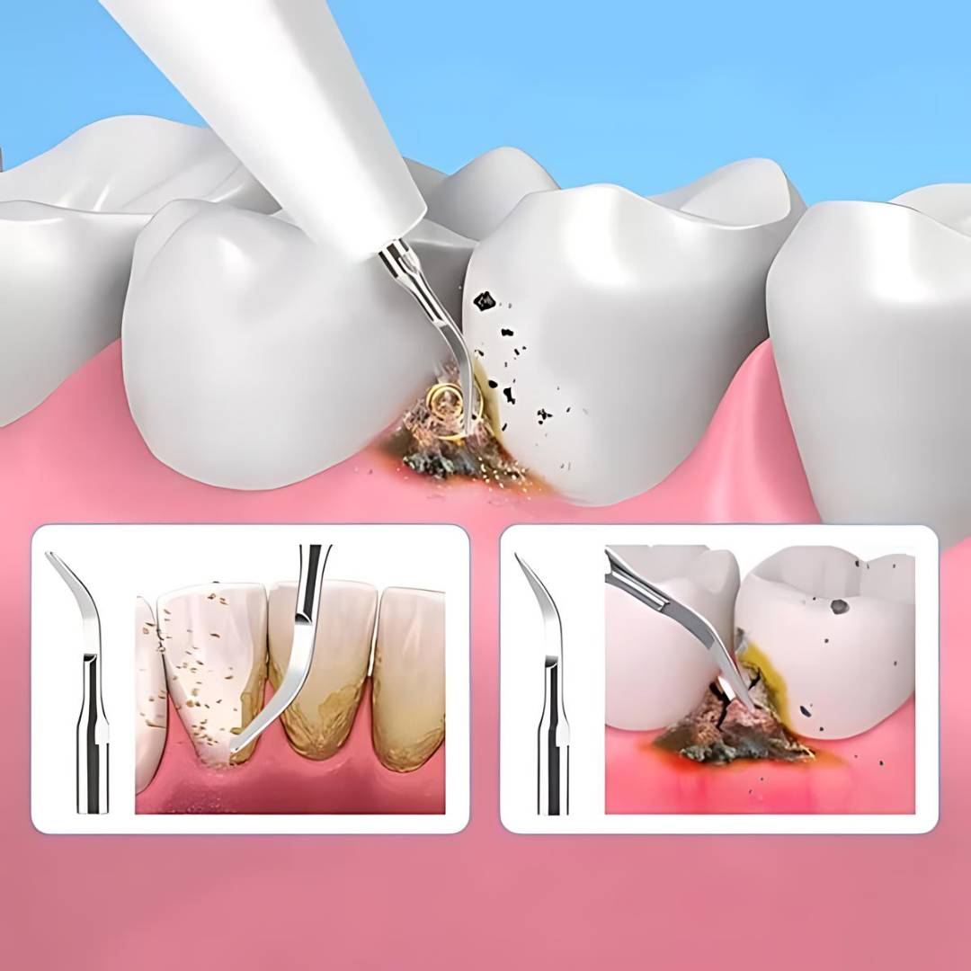 Ultrasonic Teeth Cleaner | Deep Plaque & Tartar Remover for Home Use, Promotes Gum Health