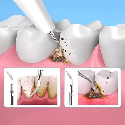 Ultrasonic Teeth Cleaner | Deep Plaque & Tartar Remover for Home Use, Promotes Gum Health
