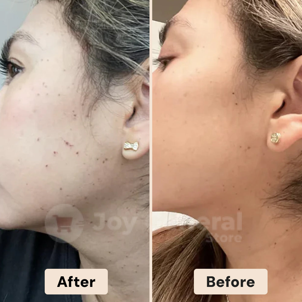 Picosecond Laser Pen for Dark Spot Removal - Light Therapy Skin Treatment Device for Hyperpigmentation and Age Spots