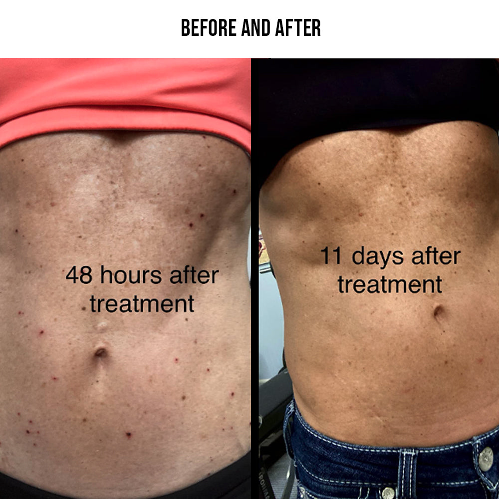 Skin Tag Remover Pen for Moles, Warts, Age Spots & Freckles - Complete Starter Kit for At-Home Skin Treatment