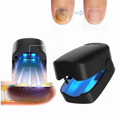 LumiCure PRO 2.0 - Mycosis Nail Fungus Treatment Laser Device for Effective Fungal Infection Removal at Home