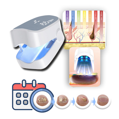 Laser Treatment for Nail Fungus | Painless Nail Fungal Nail Treatment Device for Treating a Fungal Nail & Fast Toe Fungus Relief.